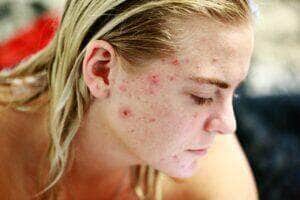 Cuidado! Espinhas podem infeccionar