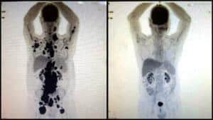 São Paulo (SP) - Com a terapia celular CAR-T Cell, o paciente Paulo Peregrino, 61 anos, teve remissão completa de um linfoma em apenas um mês. Foto: Arquivo pessoal