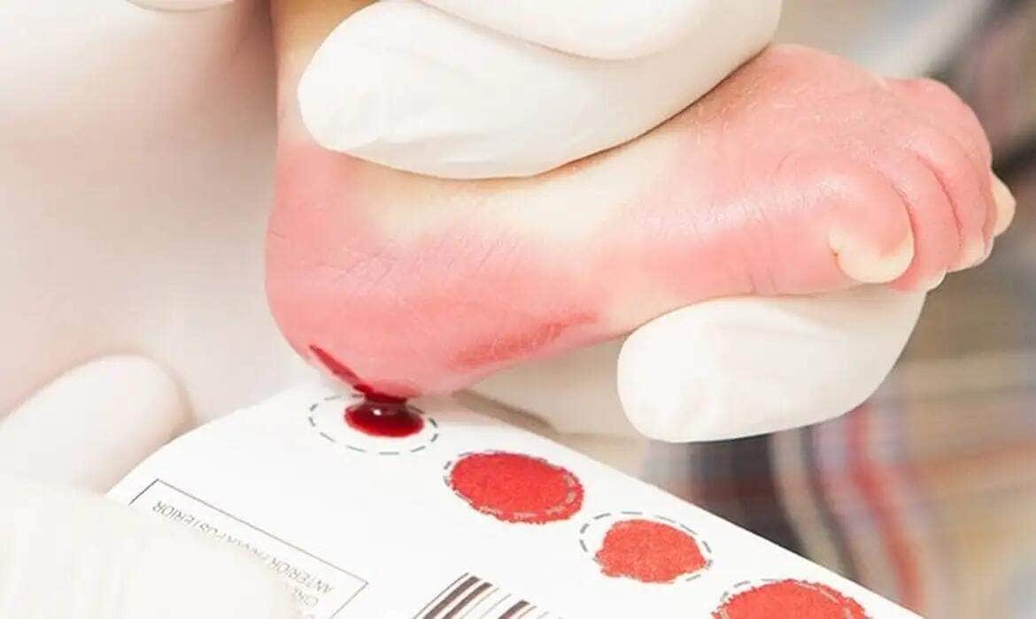 Exame detecta precocemente doenças metabólicas, genéticas e infecciosas, que poderão causar alterações no desenvolvimento neuropsicomotor do bebê. Por: Ascom/PMI