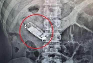 Raio-X revelou que aparelho engolido obstruía sistema digestivo do preso; Sejus-MT investiga falha na segurança