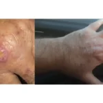 Especialistas alertam para falta de informação sobre leishmaniose no Rio