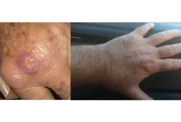 Especialistas alertam para falta de informação sobre leishmaniose no Rio