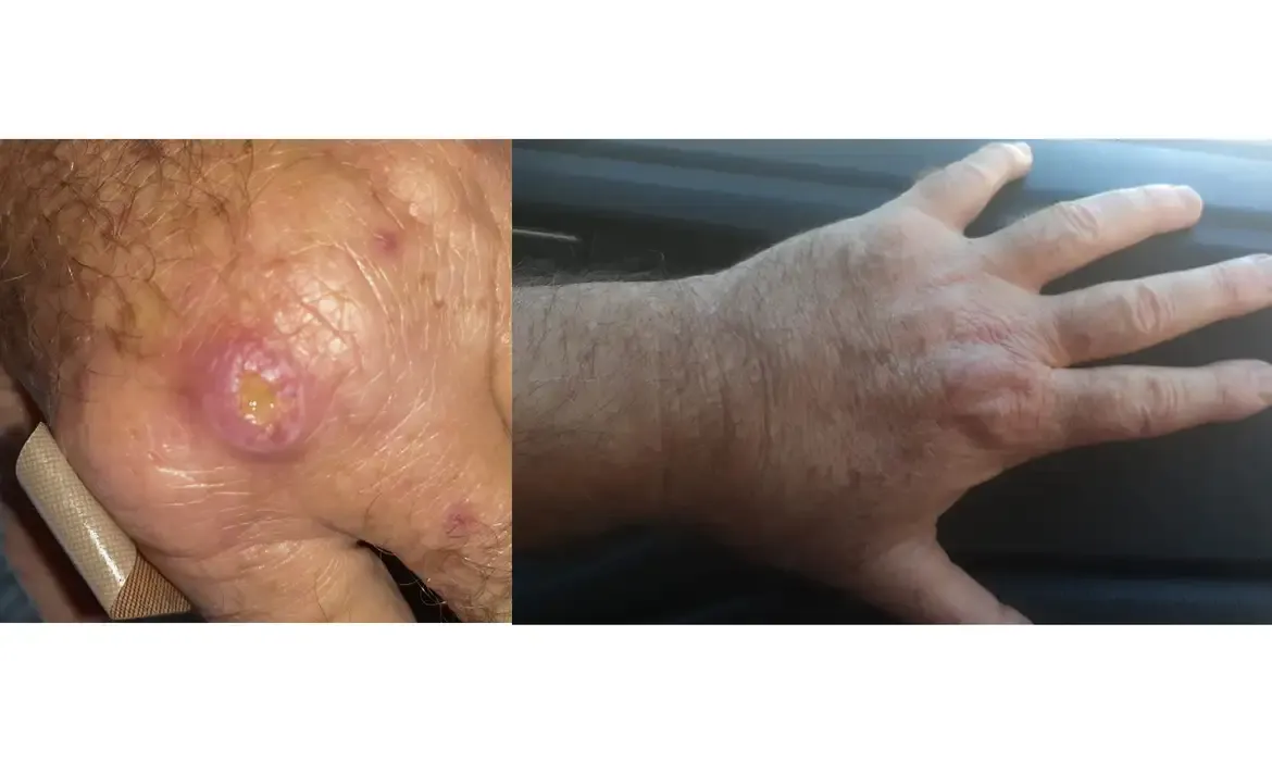 Especialistas alertam para falta de informação sobre leishmaniose no Rio