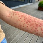 Primavera do Leste amplia vacinação e aplica mais de 5 mil doses contra o sarampo