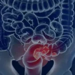 Pacientes com câncer colorretal enfrentam diagnóstico tardio e alto risco