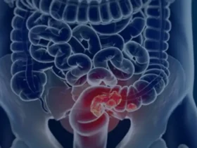 Pacientes com câncer colorretal enfrentam diagnóstico tardio e alto risco