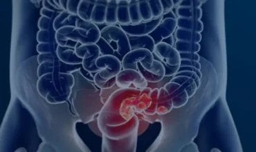 Pacientes com câncer colorretal enfrentam diagnóstico tardio e alto risco