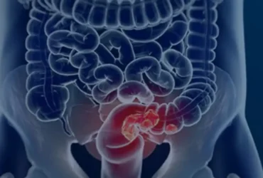 Pacientes com câncer colorretal enfrentam diagnóstico tardio e alto risco