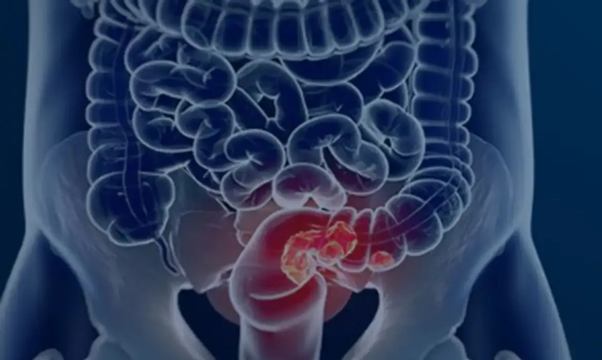 Pacientes com câncer colorretal enfrentam diagnóstico tardio e alto risco