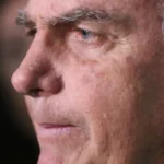 Bolsonaro passa por nova cirurgia após crise persistente de soluços