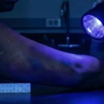 Estudo avalia uso de luzes forenses em hematomas
