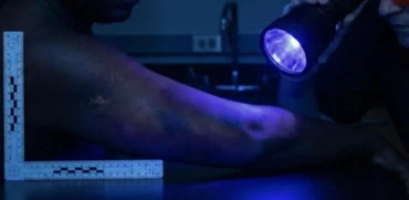 Uso de luzes forenses em análise de cadáver