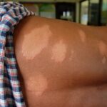 Com 1.154 pessoas em tratamento, Cuiabá usa o Janeiro Roxo para combater estigma da hanseníase