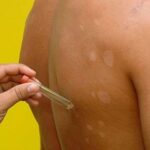 Mato Grosso lidera ranking nacional de hanseníase e enfrenta quadro hiperendêmico