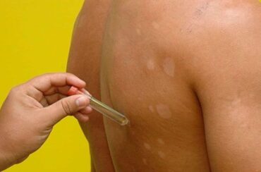 Exame em paciente com suspeita de hanseníase
