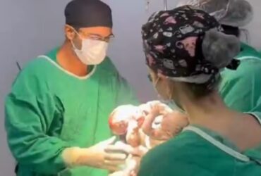 Morre o segundo gêmeo siamês de MT que nasceu em Goiânia