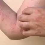 Saúde de Mato Grosso emite alerta para Mpox após casos confirmados em Rondônia