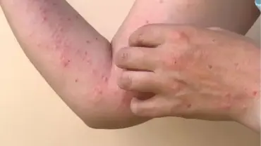 Saúde de MT emite alerta de Mpox após casos confirmados em Rondônia