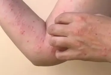 Saúde de MT emite alerta de Mpox após casos confirmados em Rondônia