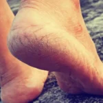 Calcanhares rachados: por que surgem e como tratar o problema de forma eficaz