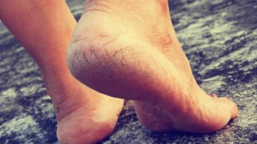 Calcanhares rachados: por que surgem e como tratar o problema de forma eficaz