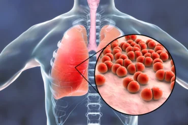 Pneumonia: como se prevenir?