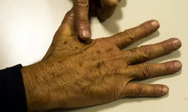 Câncer: falhas em dados oficiais prejudicam diagnóstico precoce no Brasil