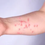 Cuiabá reforça vigilância contra Mpox e mantém status de zero casos confirmados em 2026
