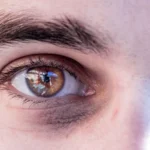 Causas das olheiras e por que a região abaixo dos olhos escurece