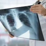 Cuiabá está entre as 13 capitais brasileiras com risco para Síndrome Respiratória Grave