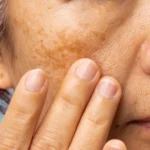 Melasma afeta milhões de pessoas e exige cuidados contínuos com a pele