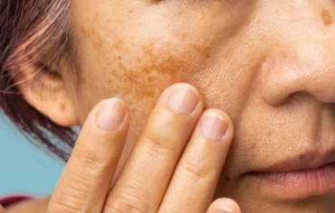 Melasma