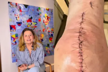 Artroplastia total de joelho: quando a cirurgia indicada a Vera Fischer é necessária?