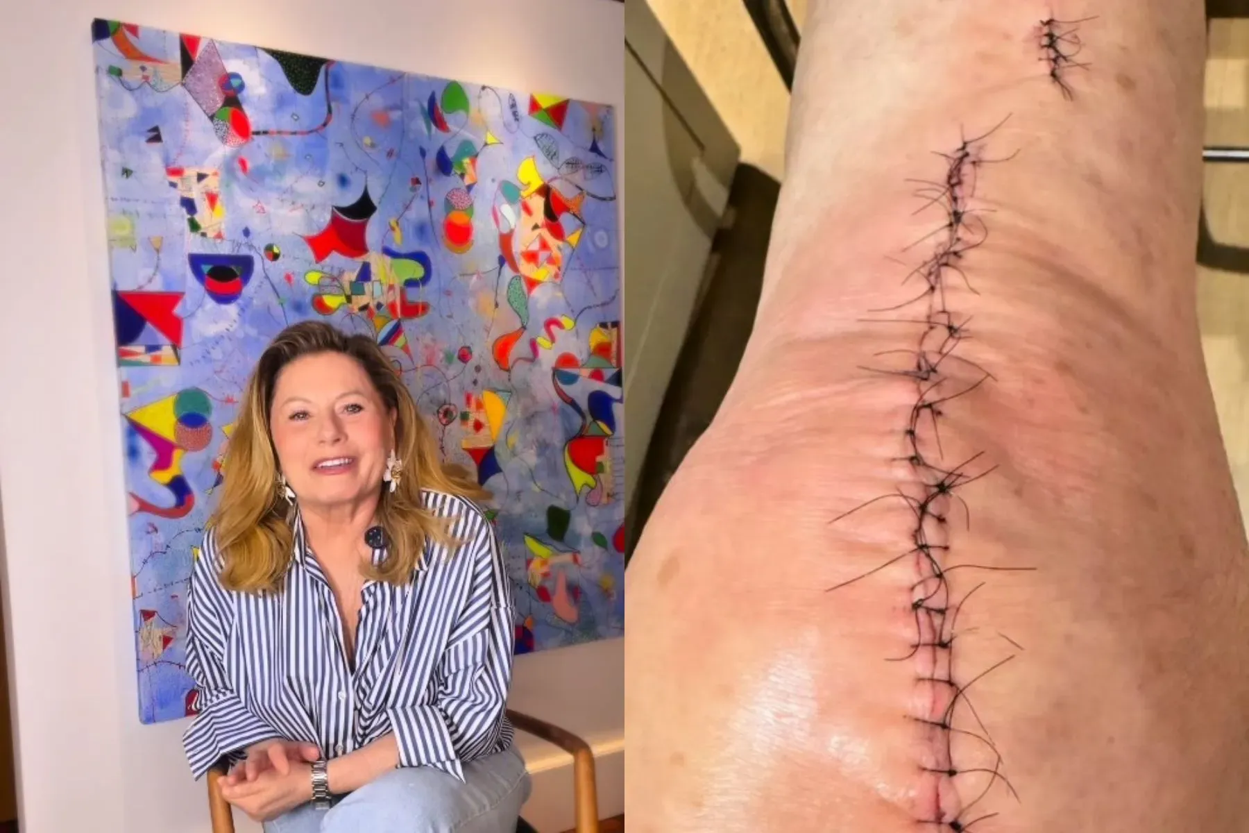 Artroplastia total de joelho: quando a cirurgia indicada a Vera Fischer é necessária?