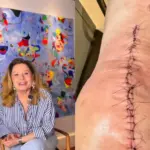 Vera Fischer revela cirurgia no joelho e explica decisão: ‘Preferi viver’