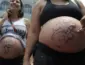 Cesariana: pesquisa aponta fatores sociais e estruturais por trás da alta no Brasil