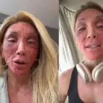 Peeling: Maya Massafera explica inchaço no rosto