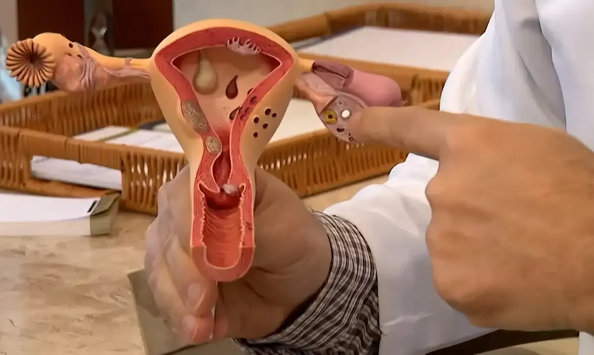 Endometriose: chamada pública destina R$ 60 milhões para pesquisas no SUS