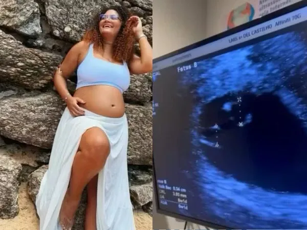 Superfetação faz mulher gerar três meninas